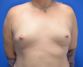 Gender Confirmation Top Surgery