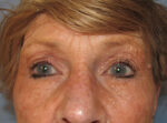 Blepharoplasty