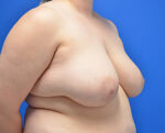 Breast Reduction/Breast Lift