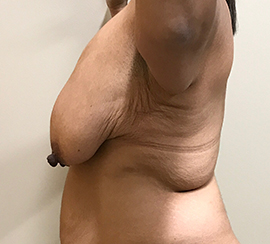 Breast Reduction/Breast Lift