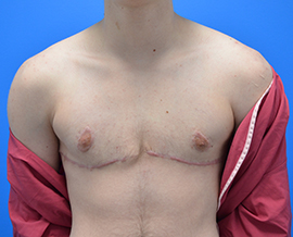 Gender Confirmation Top Surgery