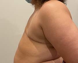 Gender Confirmation Top Surgery