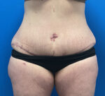 Tummy Tuck