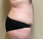 Tummy Tuck