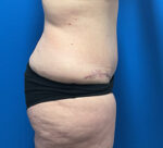 Tummy Tuck