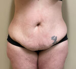 Tummy Tuck
