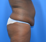 Tummy Tuck