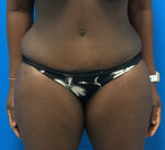 Tummy Tuck
