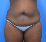 Tummy Tuck