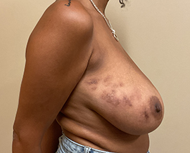 Breast Reduction/Breast Lift