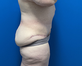 After Weight Loss