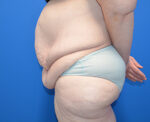 After Weight Loss