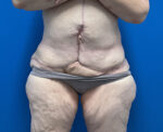 After Weight Loss
