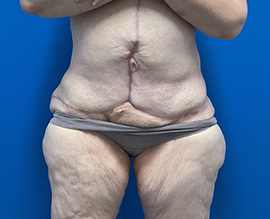After Weight Loss