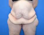 After Weight Loss