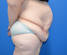 After Weight Loss