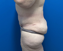 After Weight Loss