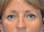 Blepharoplasty