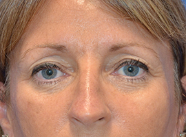 Blepharoplasty