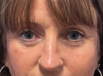 Blepharoplasty