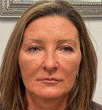 Injectable Fillers/Botox