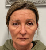 Injectable Fillers/Botox