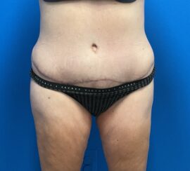 Tummy Tuck