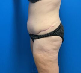 Tummy Tuck