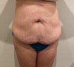Tummy Tuck