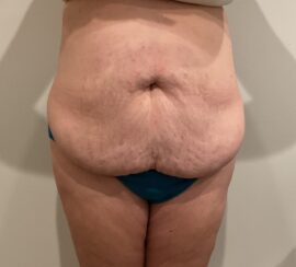 Tummy Tuck