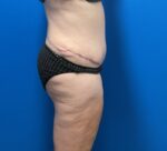 Tummy Tuck