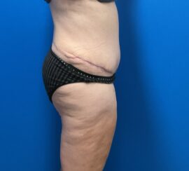 Tummy Tuck