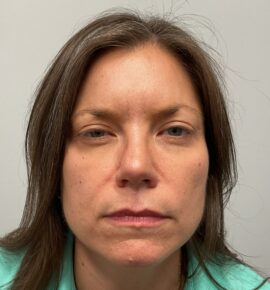 Injectable Fillers/Botox