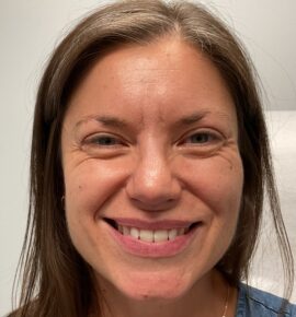 Injectable Fillers/Botox