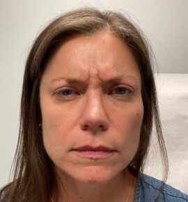 Injectable Fillers/Botox