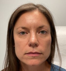 Injectable Fillers/Botox