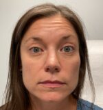 Injectable Fillers/Botox