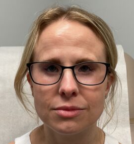 Injectable Fillers/Botox