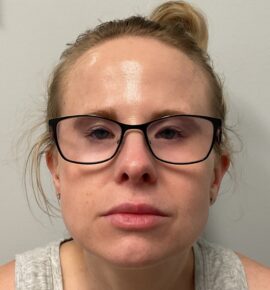 Injectable Fillers/Botox