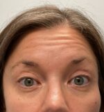 Injectable Fillers/Botox