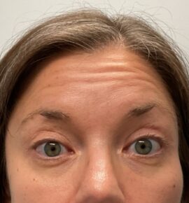 Injectable Fillers/Botox