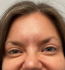 Injectable Fillers/Botox