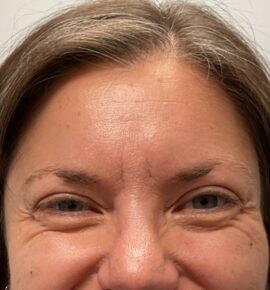 Injectable Fillers/Botox