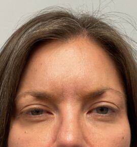 Injectable Fillers/Botox