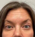 Injectable Fillers/Botox