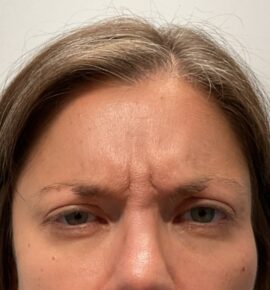 Injectable Fillers/Botox