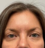 Injectable Fillers/Botox