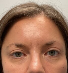 Injectable Fillers/Botox