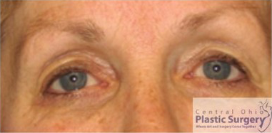 Eyelid Surgery (Blepharoplasty) Before Photo