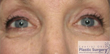 Eyelid Surgery (Blepharoplasty) After Photo